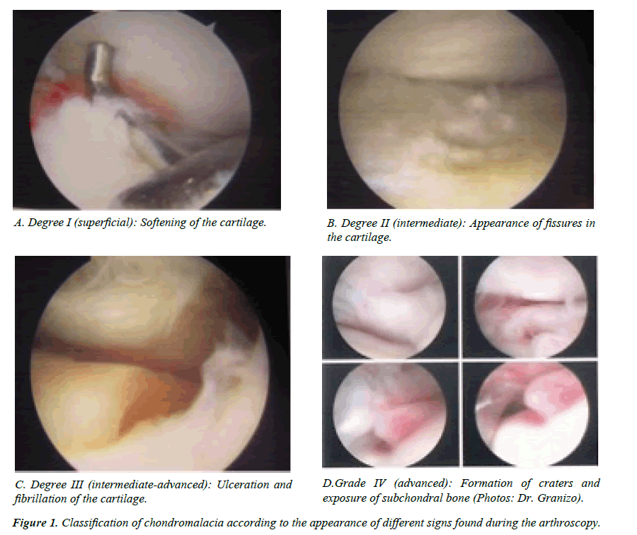 case-reports-in-surgery-invasive-procedures-Classification-chondromalacia