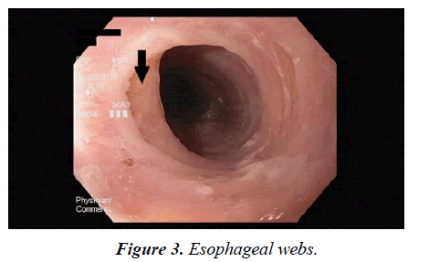 case-reports-in-surgery-invasive-procedures-Esophageal-webs