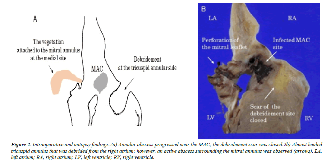 case-reports-in-surgery-invasive-procedures-Intraoperative-autopsy-findings