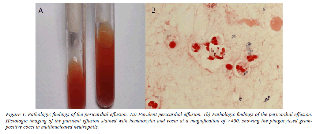 case-reports-in-surgery-invasive-procedures-Pathologic-pericardial-effusion