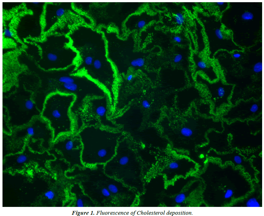 cholesterol-and-heart-disease-Cholesterol-deposition