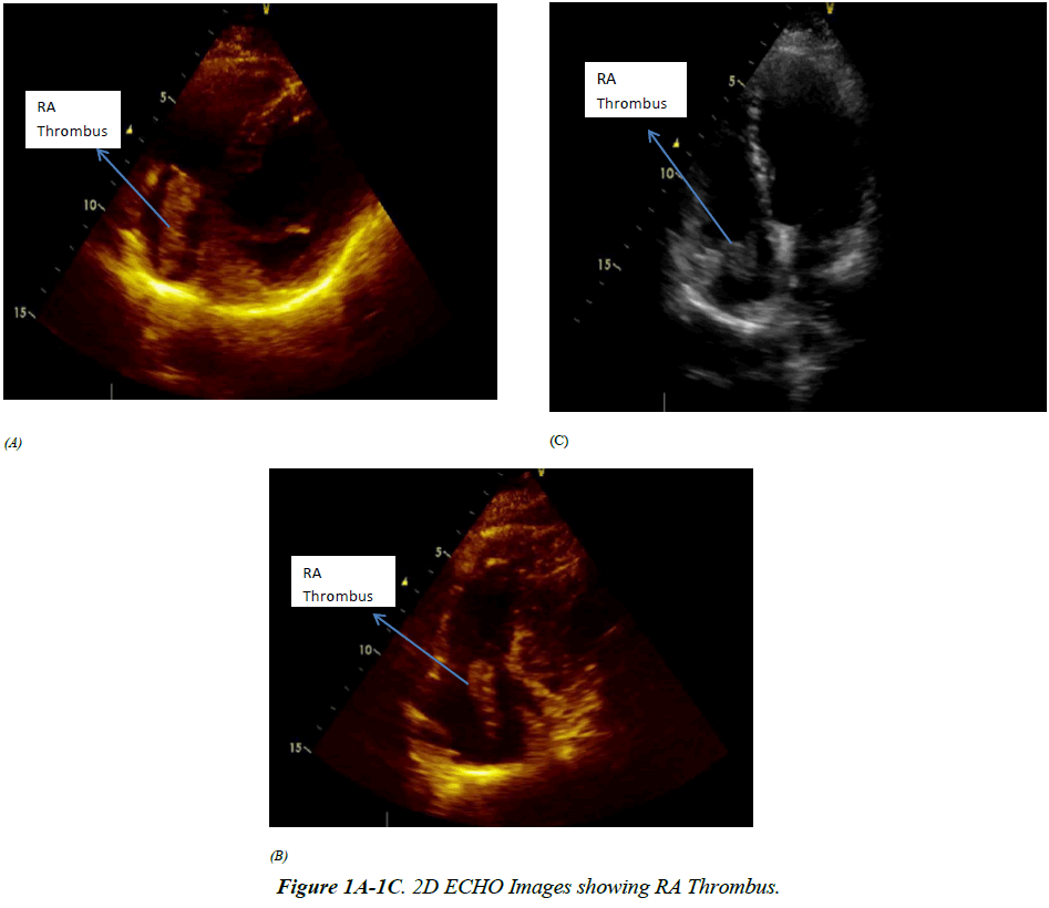 cholesterol-and-heart-disease-ECHO-Images