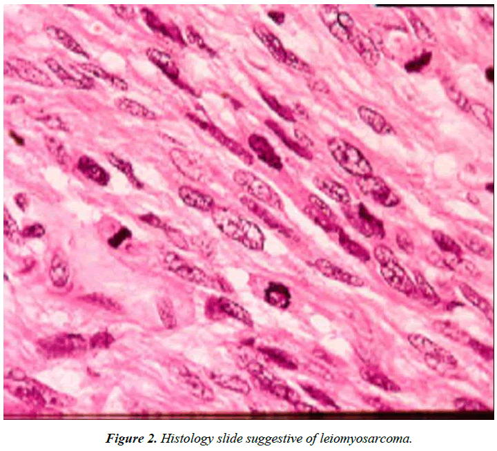 cholesterol-and-heart-disease-leiomyosarcoma