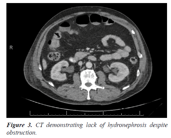 clincal-nephrology-therapeutics-hydronephrosis-despite