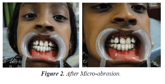 clinical-dentistry-Micro-abrasion