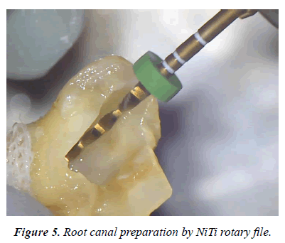 clinical-dentistry-Root-canal-preparation