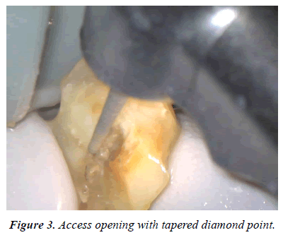 clinical-dentistry-diamond-point