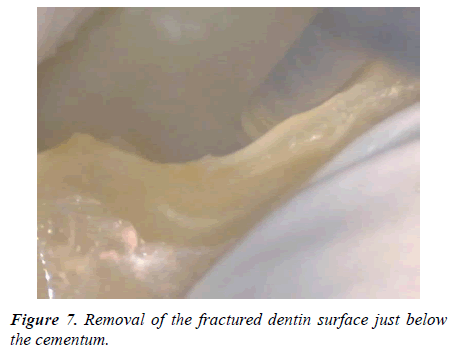 clinical-dentistry-fractured-dentin-surface