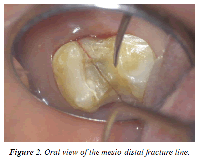 clinical-dentistry-mesio-distal-fracture