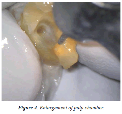 clinical-dentistry-pulp-chamber