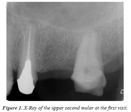 clinical-dentistry-upper-second-molar