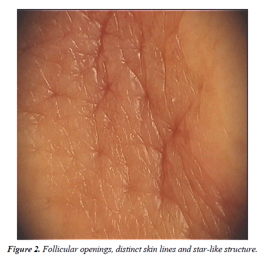 clinical-dermatology-Follicular-openings