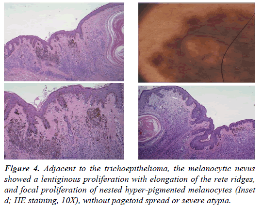 clinical-dermatology-brown-melanocytic