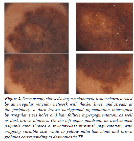 clinical-dermatology-brown-melanocytic-lesion