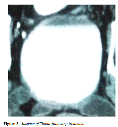 clinical-oncology-Absence-Tumor