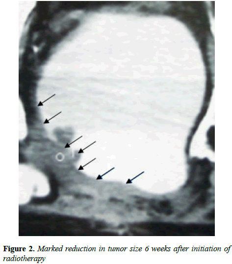 clinical-oncology-Marked-reduction