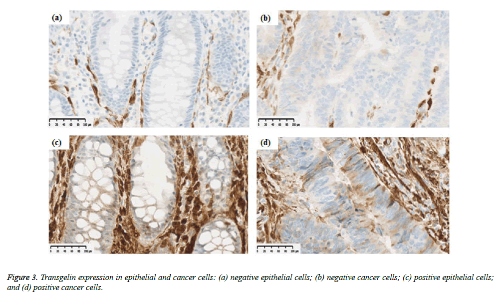 clinical-oncology-Transgelin-expression