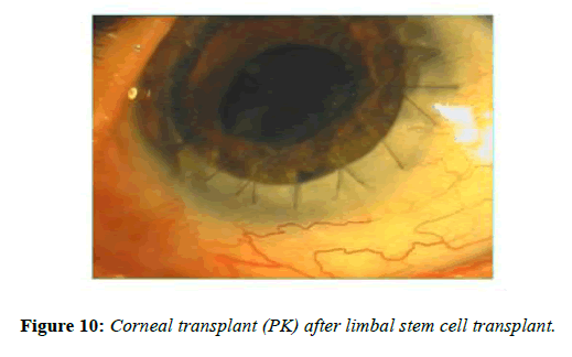clinical-ophthalmology-Corneal-transplant
