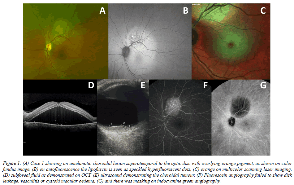 clinical-ophthalmology-amelanotic-choroidal