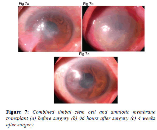 clinical-ophthalmology-amniotic-membrane