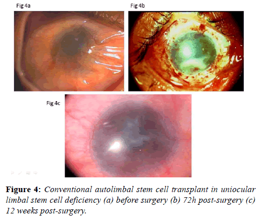 clinical-ophthalmology-autolimbal-stem