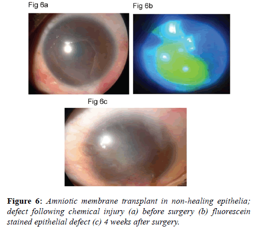 clinical-ophthalmology-autolimbal-stem