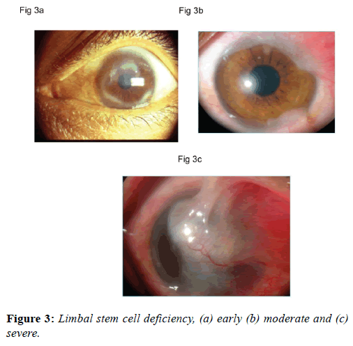 clinical-ophthalmology-cell-deficiency