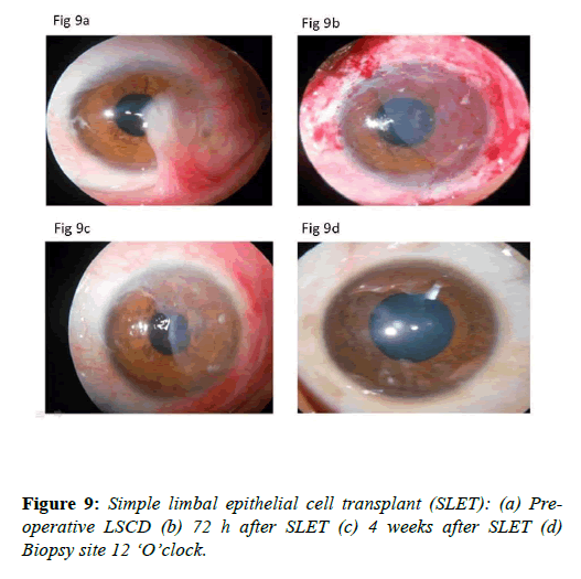 clinical-ophthalmology-cell-transplant