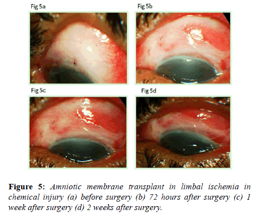 clinical-ophthalmology-chemical-injury