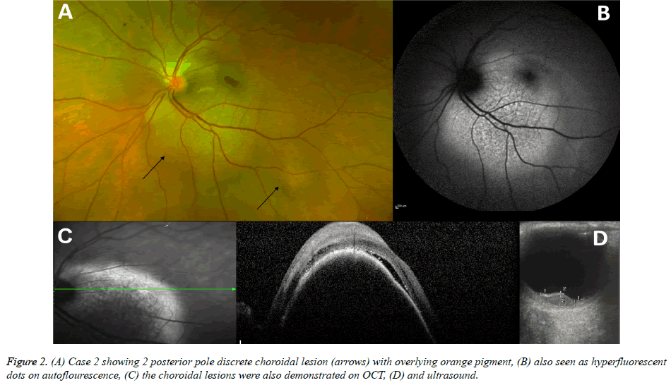 clinical-ophthalmology-discrete-choroidal