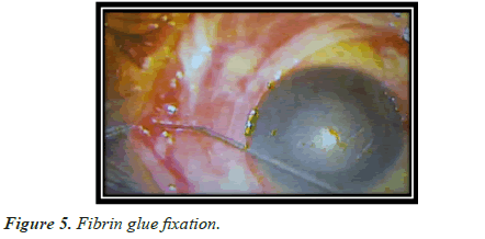 clinical-ophthalmology-fixation
