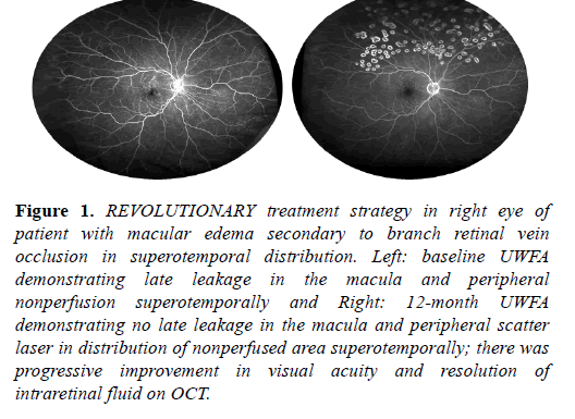 clinical-ophthalmology-macular-edema