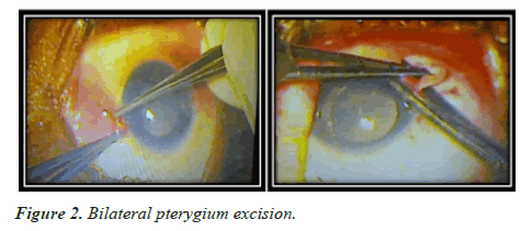 clinical-ophthalmology-pterygium