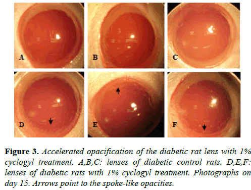 clinical-ophthalmology-science-diabetic-opacities
