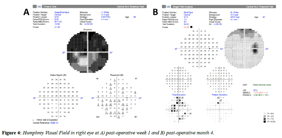 clinical-ophthalmology-vision-Humphrey-Visual