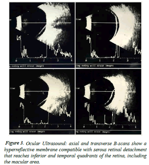 clinical-ophthalmology-vision-Ocular-Ultrasound