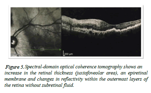 clinical-ophthalmology-vision-Spectral-domain