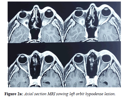 clinical-ophthalmology-vision-science-Axial-section