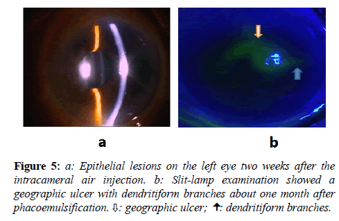 clinical-ophthalmology-vision-science-Epithelial-lesions