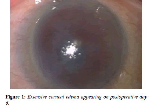 clinical-ophthalmology-vision-science-Extensive-corneal