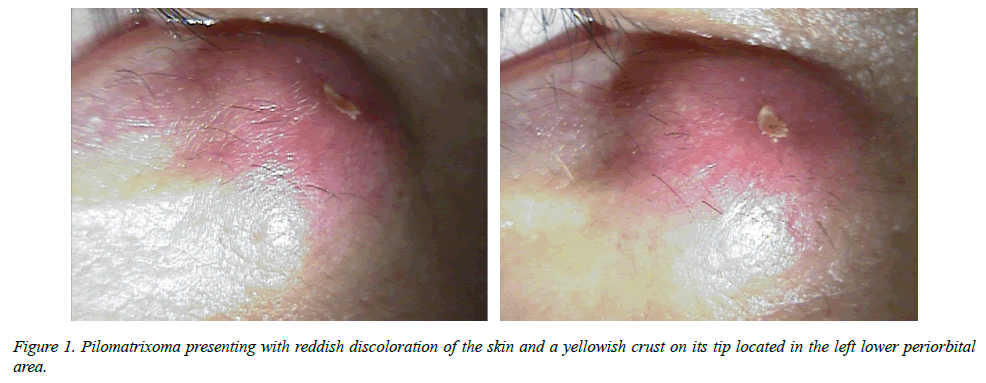 clinical-ophthalmology-vision-science-Pilomatrixoma-presenting