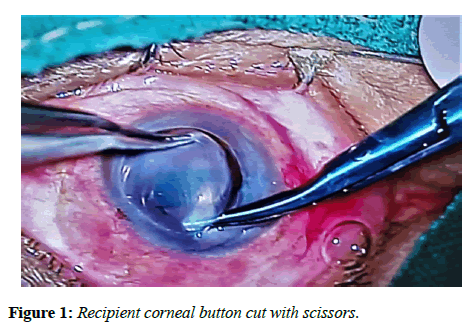 clinical-ophthalmology-vision-science-Recipient-corneal