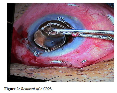 clinical-ophthalmology-vision-science-Removal-ACIOL