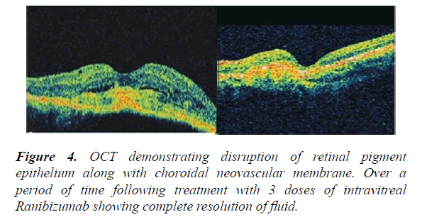 clinical-ophthalmology-vision-science-choroidal