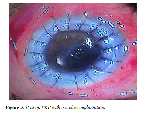 clinical-ophthalmology-vision-science-claw-implantation