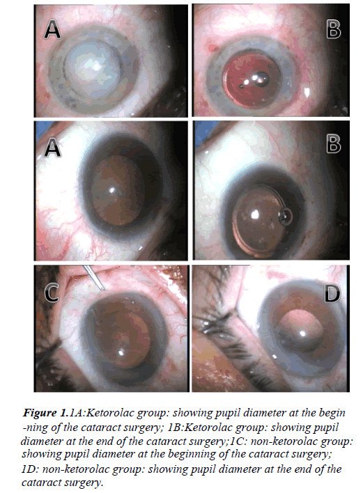 clinical-ophthalmology-vision-science-diameter