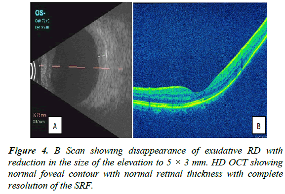 clinical-ophthalmology-vision-science-disappearance