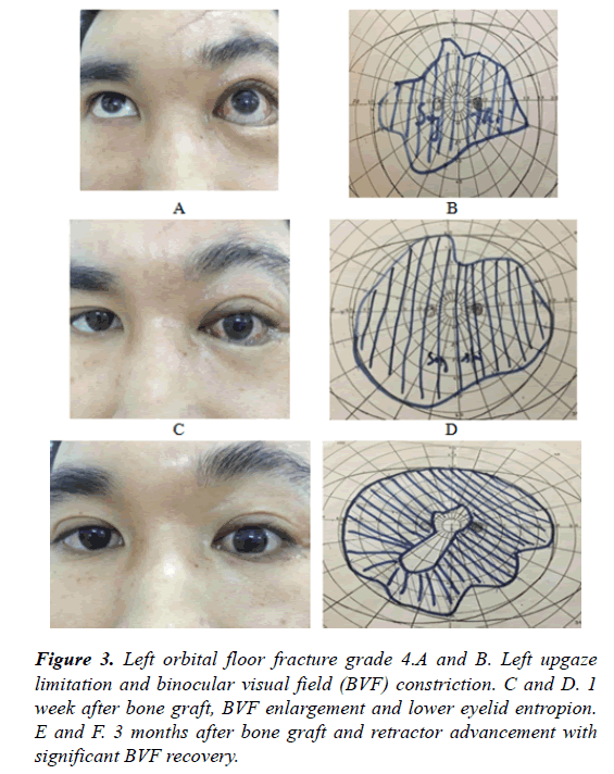 clinical-ophthalmology-vision-science-fracture