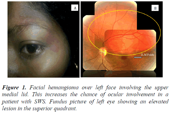 clinical-ophthalmology-vision-science-hemangioma