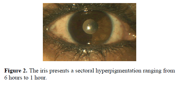 clinical-ophthalmology-vision-science-hyperpigmentation